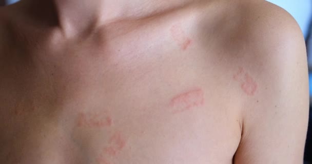 Red Spots Skin Woman Closeup Movie Allergic Eczema Diagnosis Treatment — Stockvideo