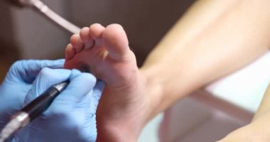 Podiatrist polishing skin on soles of feet closeup 4k movie. Foot hyperkeratosis concept