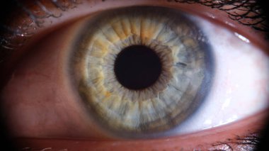 Inflamed reddened eye of girl closeup. Expansion of vessels of eye and tension from computer. Treatment of dry and inflamed eyes concept
