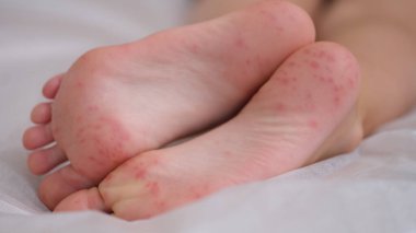 Children foot with dermatitis allergic rash. Closeup of child foot and toes with red rash and coxsackievirus enterovirus
