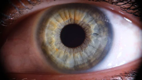 Inflamed Reddened Eye Girl Closeup Expansion Vessels Eye Tension Computer — Fotografia de Stock