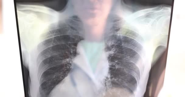 Närbild Röntgen Lungor Läkare Utför Medicinsk Diagnos Pneumoni Medicin Och — Stockvideo