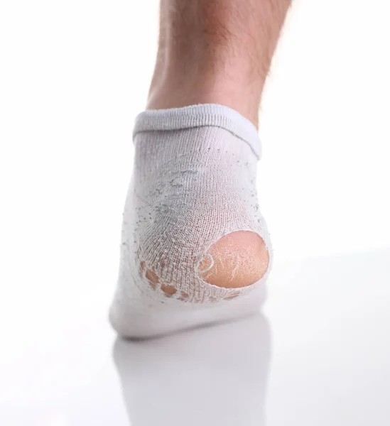 Zerrissene Weiße Socke Bein Des Mannes Nahaufnahme Armutsarmut Und Tragesocken — Stockfoto