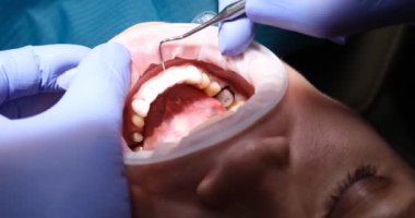 Modern dişçilikte kadınlar için porselen kaplama işlemleri ve kurulumu. Diş sağlığı konsepti