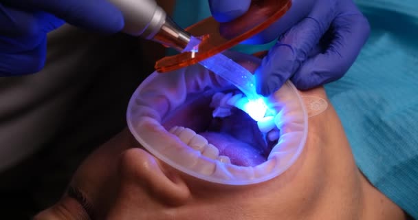 Οδοντίατρος Καθορίζει Θηλυκά Veneers Και Κεραμικά Στεφάνια Στα Δόντια Λάμπα — Αρχείο Βίντεο