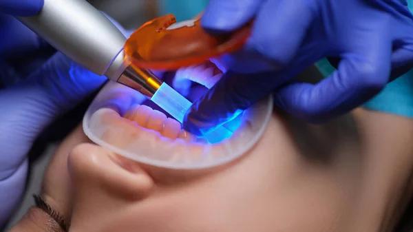 Zahnarzt Beleuchtet Füllung Mit Modernem Licht Lampe Der Klinik Nahaufnahme — Stockfoto