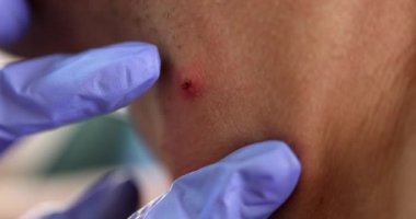 Doktor lastik eldiven takıyor, kürklü amcayı muayene ediyor, hastanın boynuna yakın çekim 4K film yavaş çekim. Cilt neoplazmalarının önlenmesi ve tedavisi kavramı