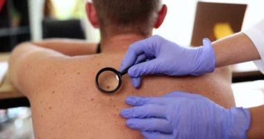 Doktor, büyüteçle yetişkin derisindeki neoplazmaları inceliyor. Deri kanseri hemanjiyom anjiyom papilloma ve köstebek teşhisi koyuyor.