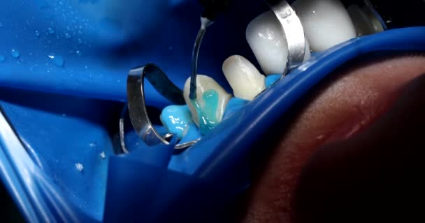 Dentista Aplicando Gel Azul Dente Antes Instalar Folheados Closeup Filme — Vídeo de Stock