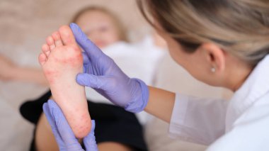 Doktor, kırmızı kaşıntılı bir kızarıklıkla çocuğun bacağını muayene ediyor. Enterovirüs enfeksiyonu belirtileri ve tedavi konsepti