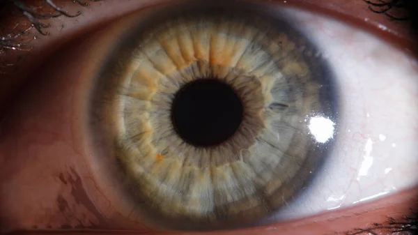 红色受损或刺激的眼睛的闭锁 红血管眼角膜概念 — 图库照片