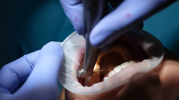Tandläkarborrar Tand Till Patient Tandstolen Tandkaries Behandling Koncept — Stockfoto