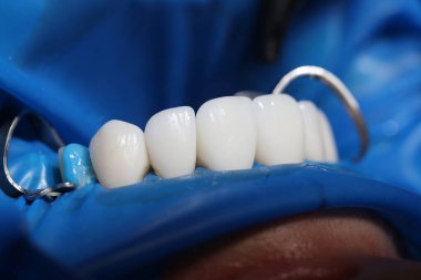 Kliniğe kaplama ve diş implantı kurulumu. Diş protezi konsepti