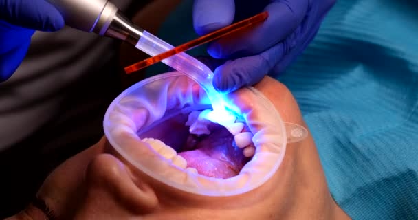 Închiderea Pacientului Sex Feminin Care Instalează Furnir Dentar Lampă Ultravioletă — Videoclip de stoc