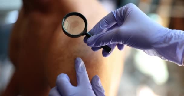 Lekarz Szkłem Powiększającym Bada Skórę Mężczyzny Bliska Konsultacja Dermatologów — Wideo stockowe