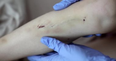 Doktor travmatolog çoklu sıyrık ve hematoma olan bir çocuğun bacağını inceliyor. Dayak kavramına karşı adli tıp incelemesi