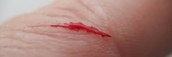 負傷した指で男のクローズアップ 開切り傷に血を出血 鋭いナイフで作られたカットのマクロ 傷の概念 — ストック写真