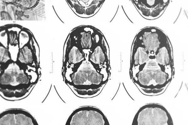 CT i mri czaszki — Zdjęcie stockowe