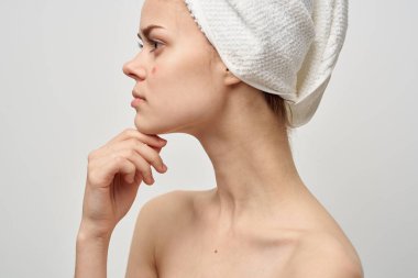 Yüzünde sivilce olan bir kadın. Cilt problemleri yakın plan.