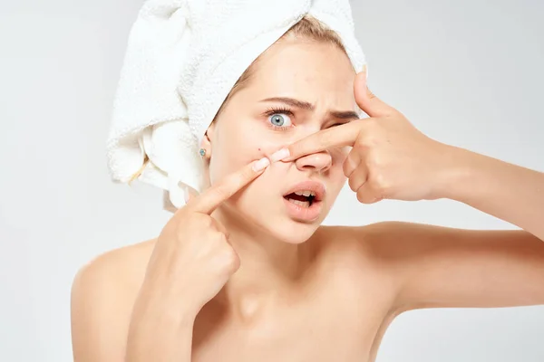 Hermosa mujer con una toalla en la cabeza acné en la dermatología de la cara — Foto de Stock