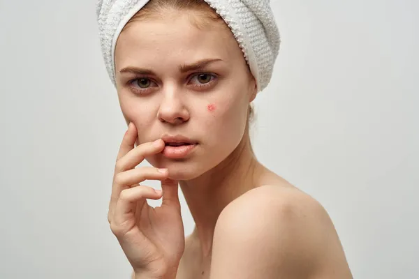 Bonita mujer con un grano en la cara cosmetología estudio — Foto de Stock