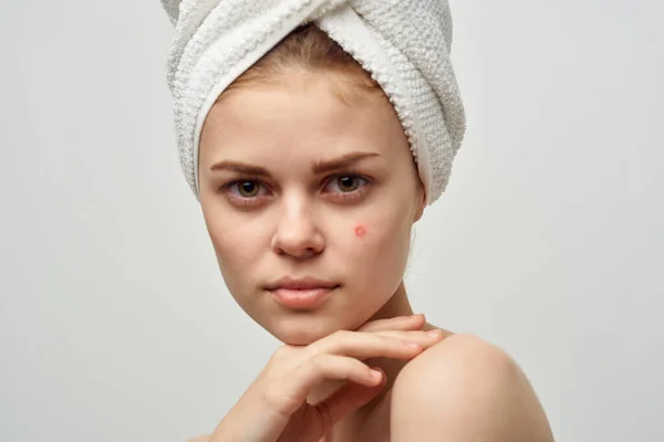 Vacker kvinna med en finne i ansiktet hudproblem närbild — Stockfoto