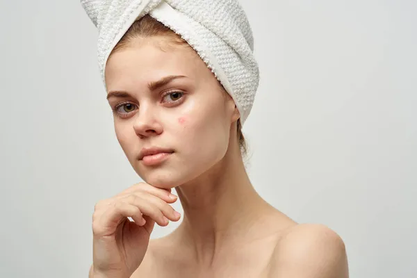 Csinos nő egy pattanás az arcon bőrproblémák közelkép — Stock Fotó