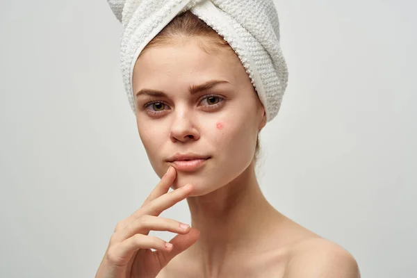 Nő pattanás az arcon bőrproblémák közelkép — Stock Fotó