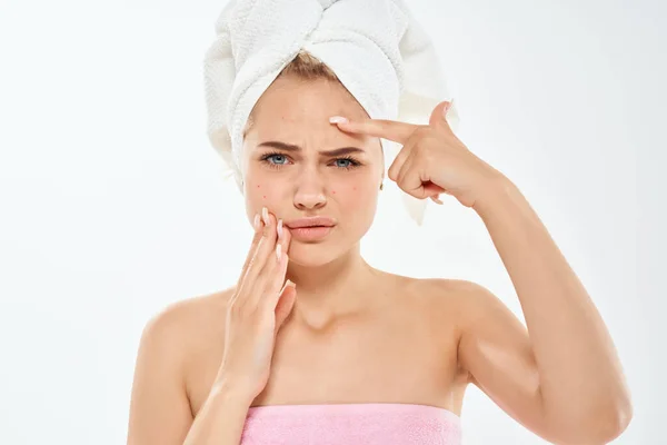 Csinos nő egy törülköző a fejemen arc bőr problémák bőrgyógyászat elégedetlenség — Stock Fotó