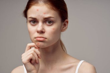 Yüz derisi sorunu olan kızıl saçlı bir kadın. Dermatolojiye yakın çekim. Yüksek kalite fotoğraf