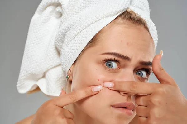 Hermosa mujer con una toalla en la cabeza acné en la cara Estudio de cerca — Foto de Stock