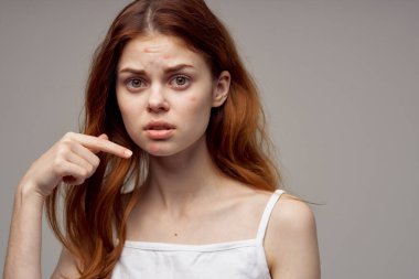 Kızıl saçlı kadın. Yüz derisi sorunları. Dermatoloji izole edilmiş.