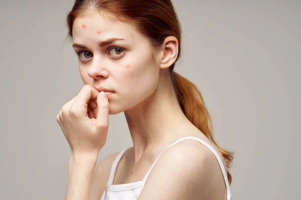 Vacker kvinna med finnar i ansiktet hygien ljus bakgrund — Stockfoto