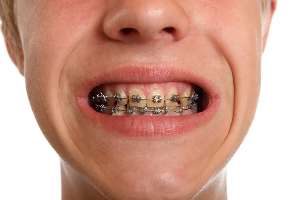 Teeth braces — Stock Photo, Image