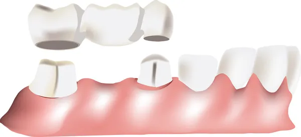 Dental bridge — Stock Vector