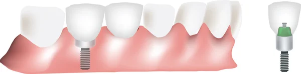 Οδοντιατρική πρόθεση — Διανυσματικό Αρχείο
