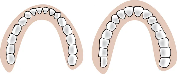 Aparelho dentário de palato superior e inferior prótese dentária- — Vetor de Stock