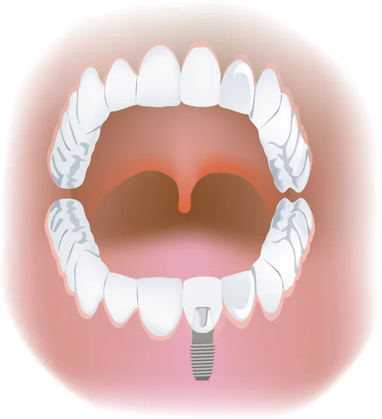 입천장의 윗부분 과 아래쪽에 있는 치아 보조 기구- — 스톡 벡터