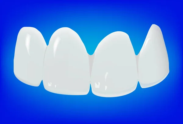 Paladar superior e inferior aparato dental prótesis dental- — Archivo Imágenes Vectoriales