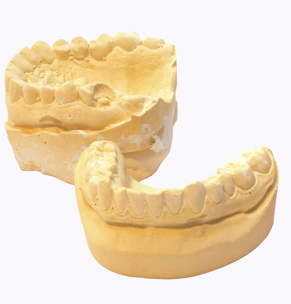 Impressão Gesso Aparelho Dentário — Fotografia de Stock