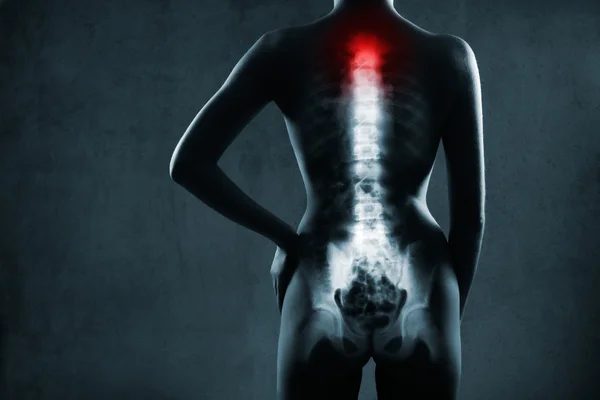 Mänskliga ryggrad i röntgen — Stockfoto