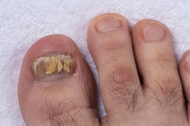 Mantar tırnağından etkilenmiş parmakları yakından çeken bir adamın ayakları. Çirkin ayak parmakları.