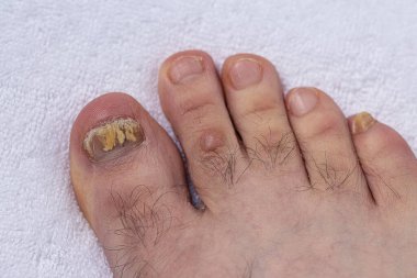 Mantar tırnağından etkilenmiş parmakları yakından çeken bir adamın ayakları. Çirkin ayak parmakları.