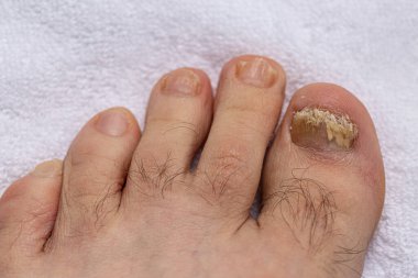 Mantar tırnağından etkilenmiş parmakları yakından çeken bir adamın ayakları. Çirkin ayak parmakları.