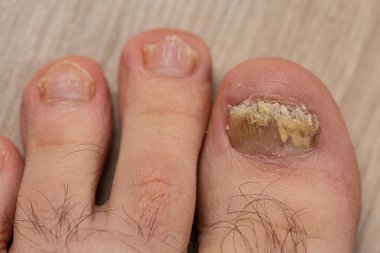 Mantar tırnağından etkilenmiş parmakları yakından çeken bir adamın ayakları. Çirkin ayak parmakları.