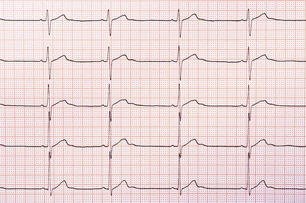 心臓のリズムのグラフ — ストック写真