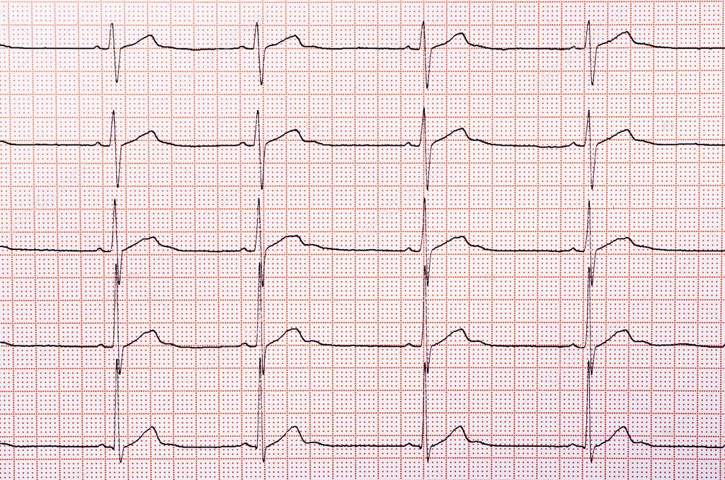 heart rhythm chart stock photo ccat82 21542883 heart rhythm chart