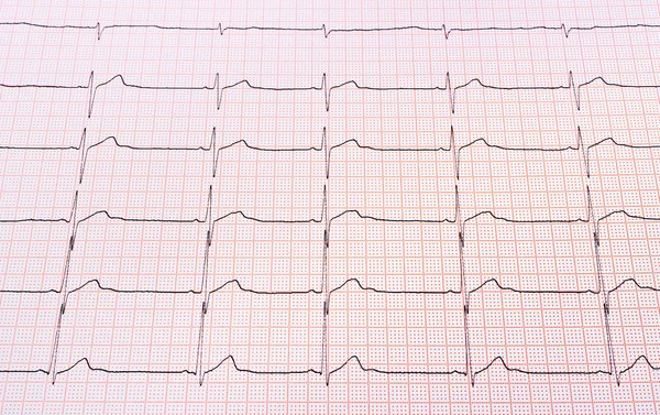 Heart rhythm chart — Stock Photo, Image