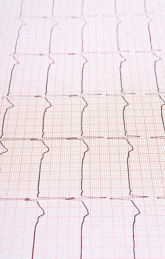 Heart Rhythm Chart