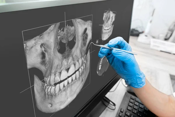 Arzt Beim Röntgen Menschlicher Zähne Auf Computerbildschirm Moderne Zahnklinik — Stockfoto